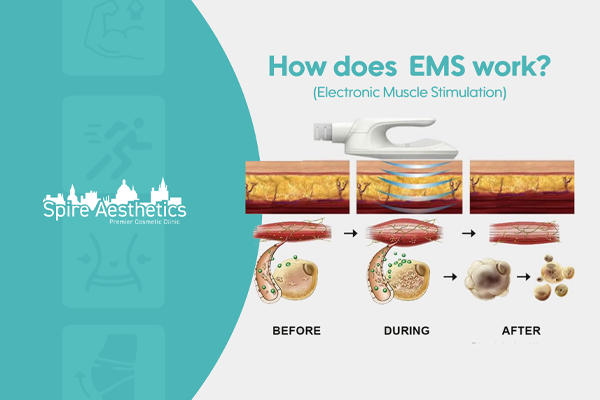 EMS treatment for post pregnancy weight loss treatment Stansted