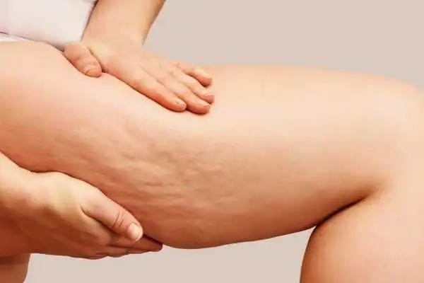 Image of woman showing leg with cellulite Stansted