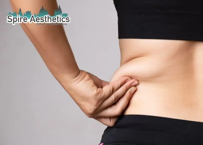 Image of woman pinching fat on their hips Stansted. Fat Freezing treatment