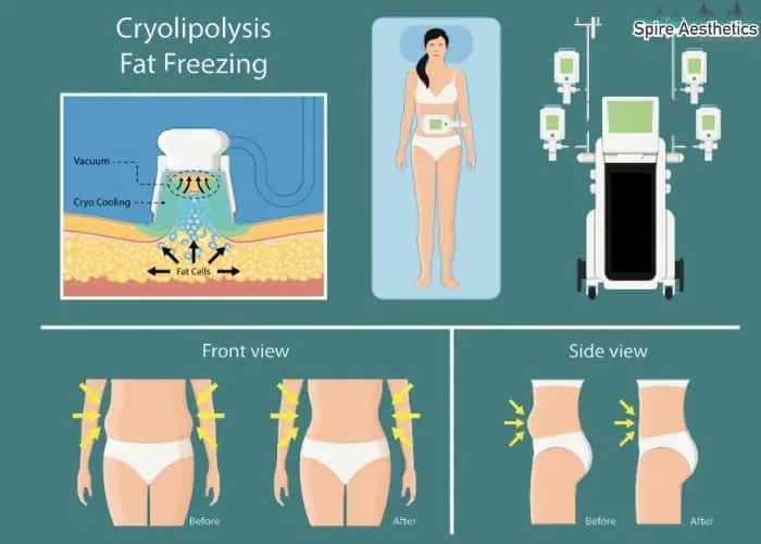 Fat freezing treatment Stansted benefits for competitions to remove stubborn fat deposits.