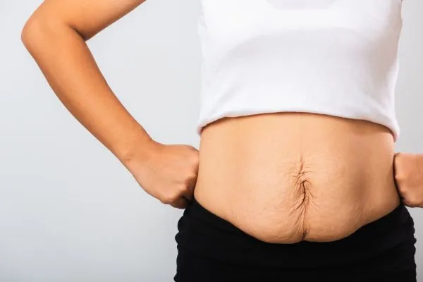 Image of a woman's stomach after weight loss with sagging skin following a gastric band Stansted