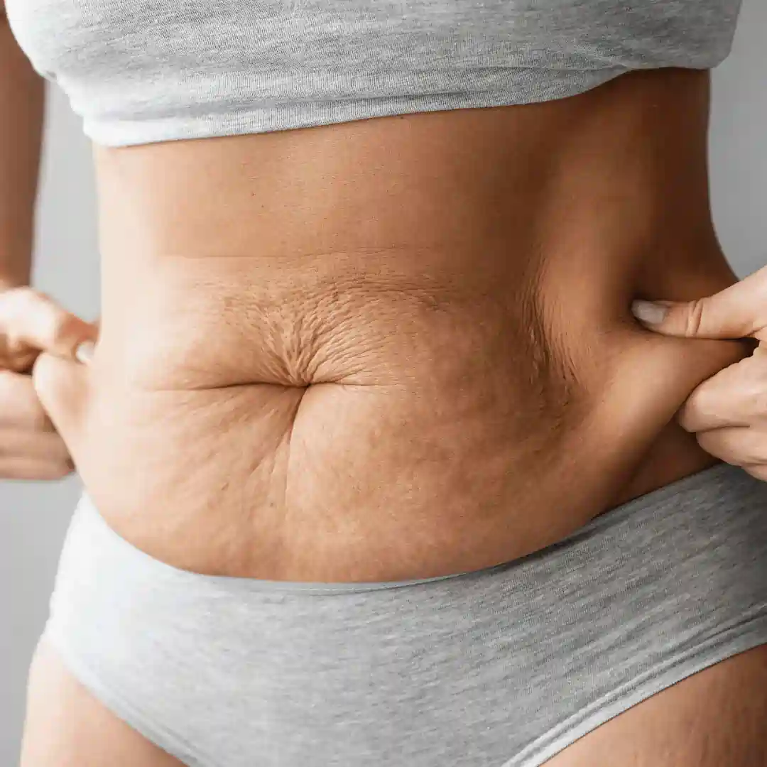 Is It Normal to Have Loose Skin After Pregnancy Stansted?