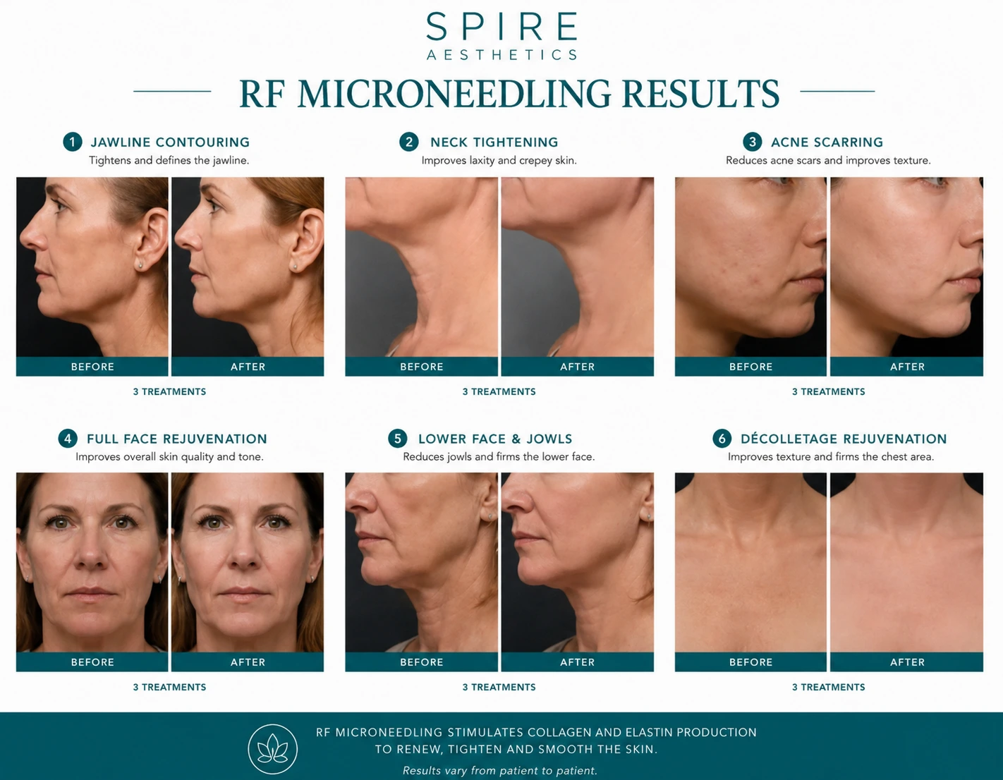 RF Microneedling Skin tightening Stansted results
