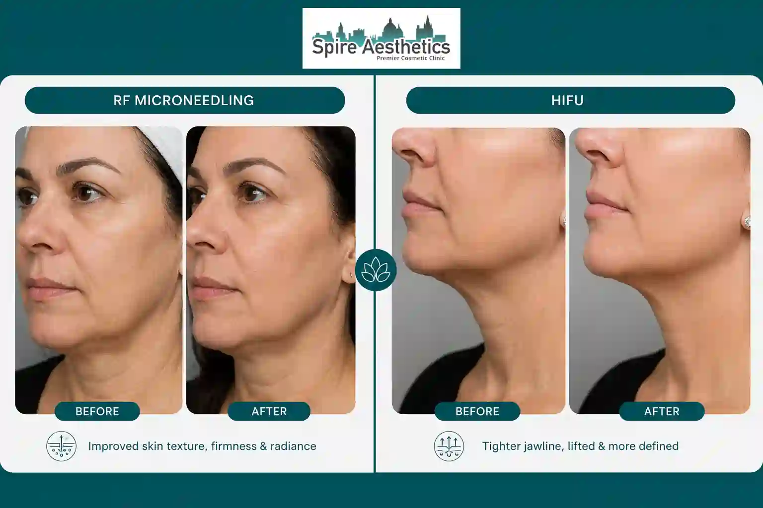 Can RF Microneedling and HIFU Be Combined Stansted?