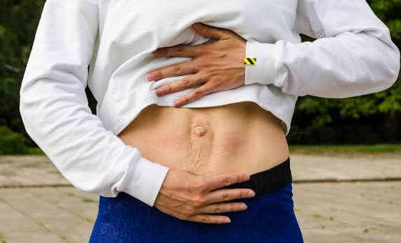 When Could Diastasis Recti Be the Missing Piece of the Puzzle Stansted?