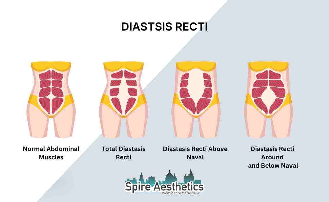 Is Non-Surgical Diastasis Recti Treatment Right for You? Common Concerns Answered Stansted